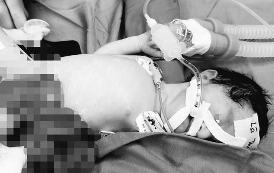 Cứu sống bé sơ sinh có nội tạng nằm ngoài ổ bụng