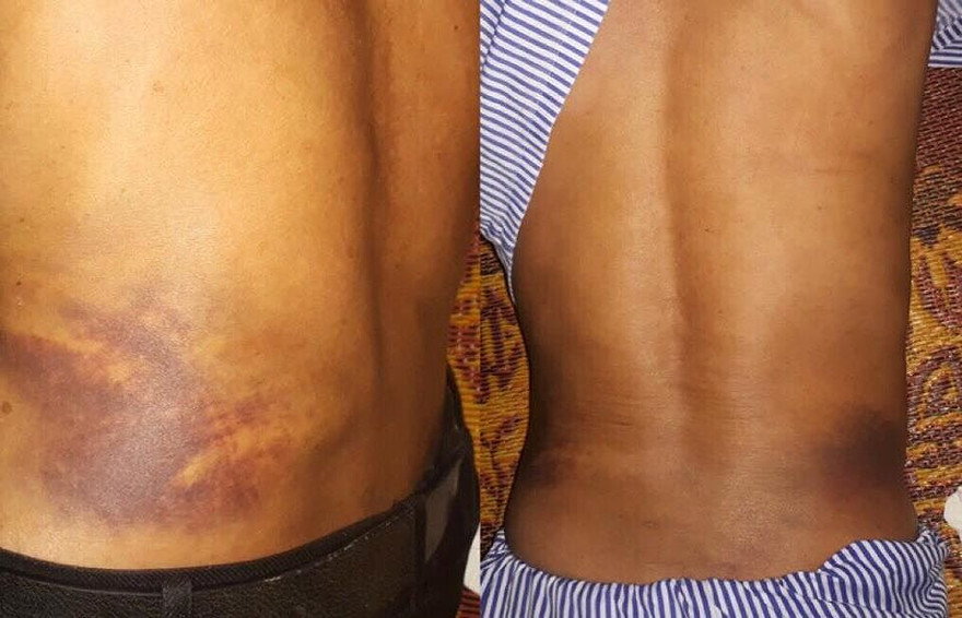 Vết thương bầm tím sau lưng ông Toàn