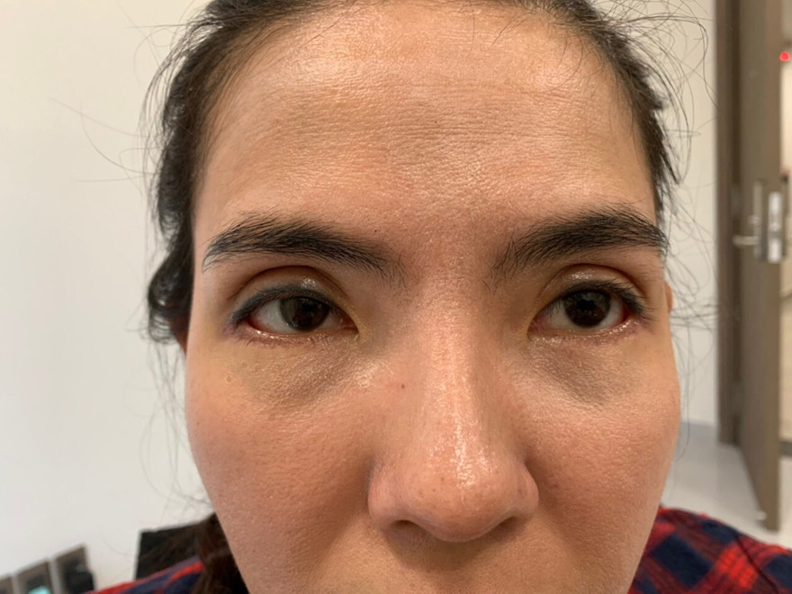 Mắt phải của chị Hồng bị lệch mí sau phẫu thuật.