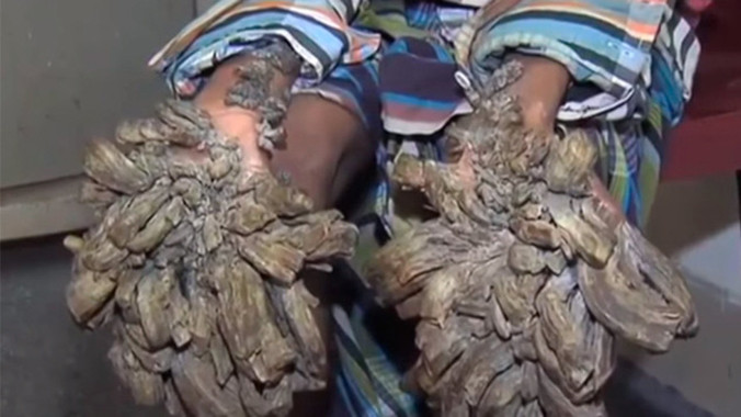 Đôi bàn tay dị dạng của Abul Bajander. Ảnh: RT