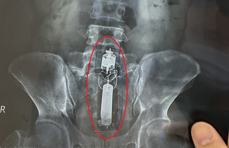 Sextoy kẹt trong trực tràng nam thanh niên.