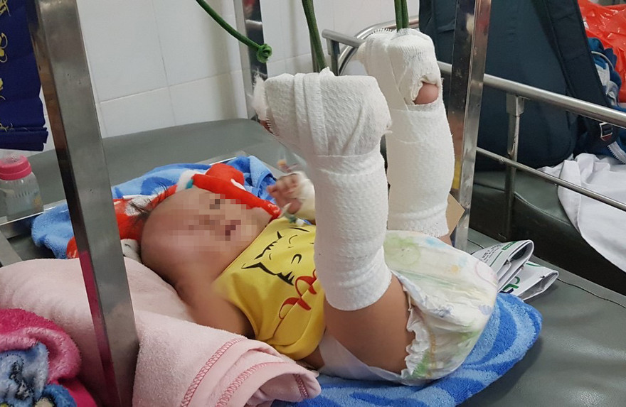 Bé trai bị bố bạo hành chấn thương nặng.