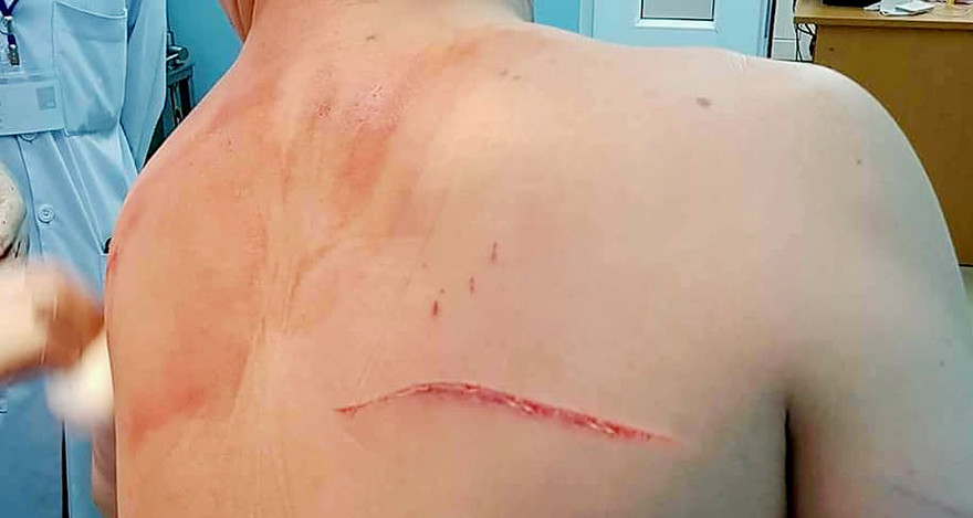 Vết chém kéo dài trên lưng bác sĩ Chiêm Quốc Thái.