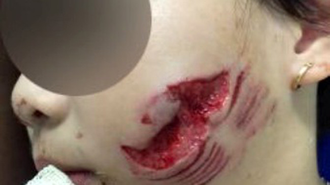 Khuôn mặt của bệnh nhi bị chó cắn nát, mất nhiều vùng cơ, da