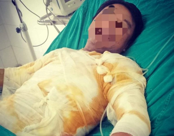 Đình chỉ 8 người liên quan vụ công nhân bị điện giật bỏng nặng