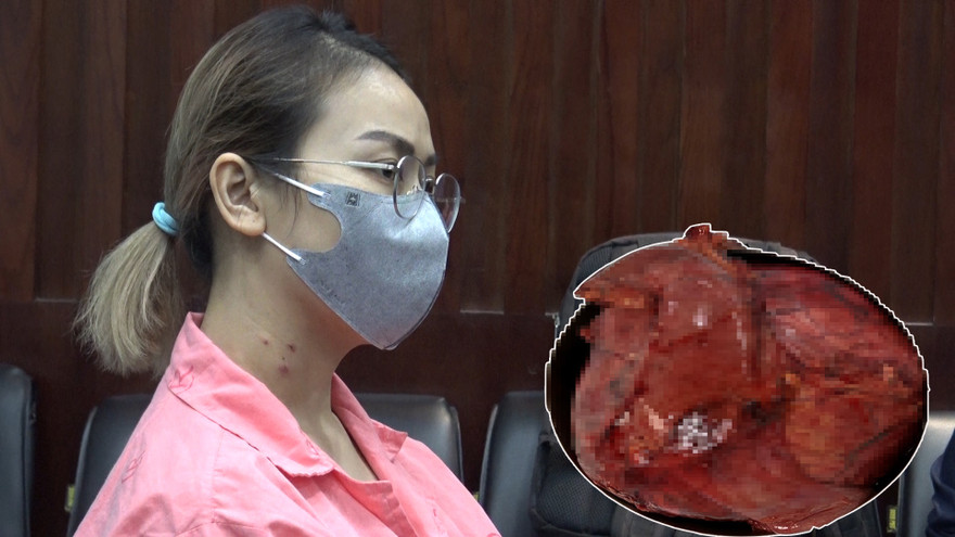 Bệnh nhân bị khối u tụy khổng lồ.