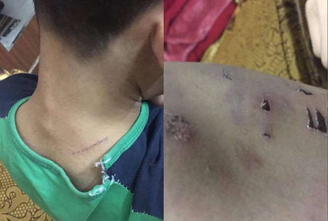 Những vết thương trên người cháu N (Ảnh: Thanh Hà)