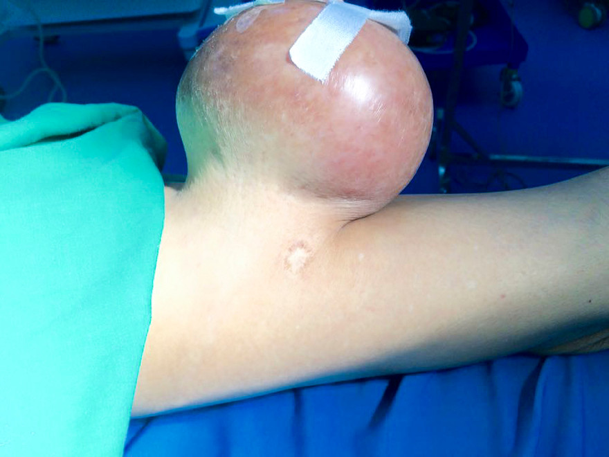 ‘Giải cứu’ người đàn ông mang khối u nặng 2kg suốt hàng chục năm