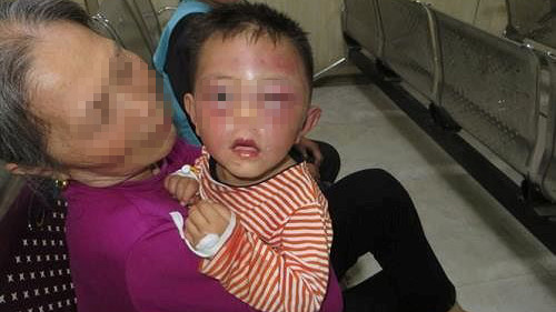 Cháu H. bị bố dượng bạo hành phải nhập viện điều trị