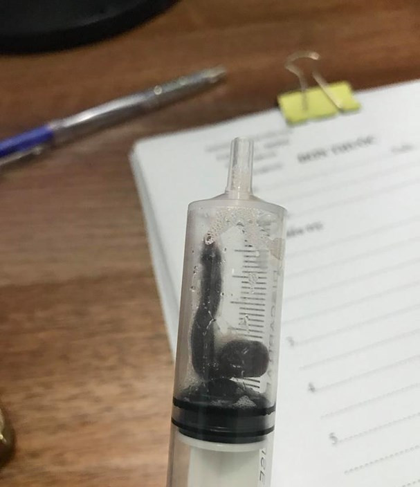 Kinh hoàng vắt sống cả tháng trong mũi của bé 8 tuổi