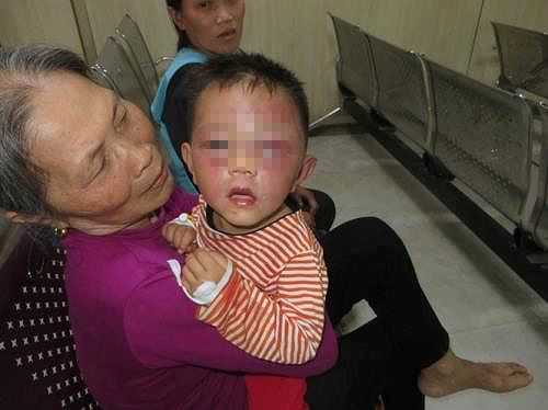 Cháu Hiếu nhập viện trong tình trạng đa chấn thương.