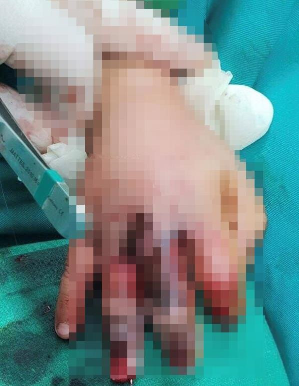 Hiếu kỳ đưa tay vào máy ép nước mía, bé 4 tuổi bị thương nặng