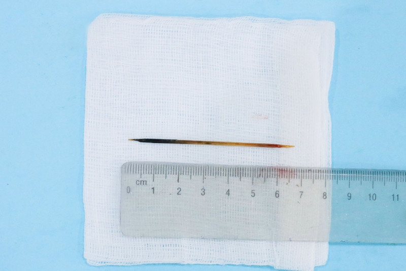 Hi hữu: Người đàn ông ngủ quên, nuốt tăm 7cm vào bụng