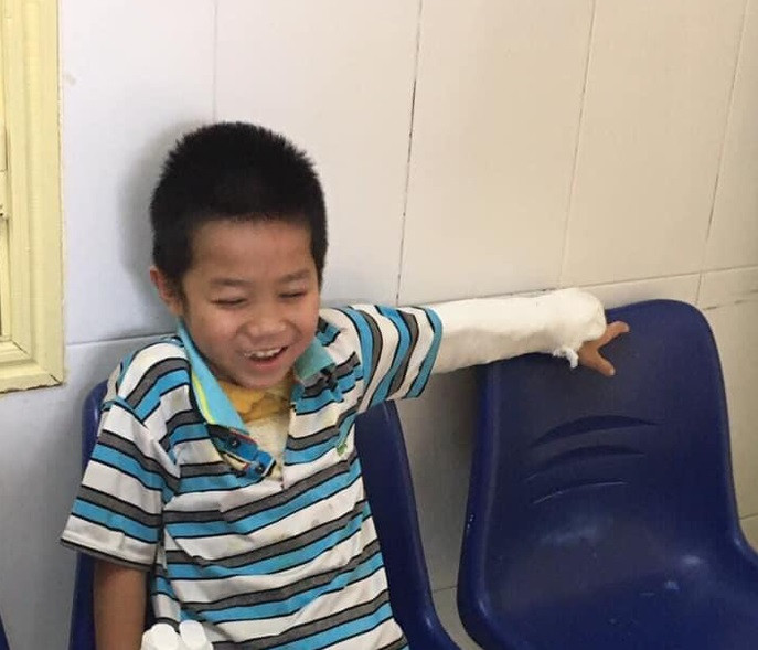 Ghép da 3 lần, bệnh nhi 7 tuổi bị bỏng nặng được cứu sống 