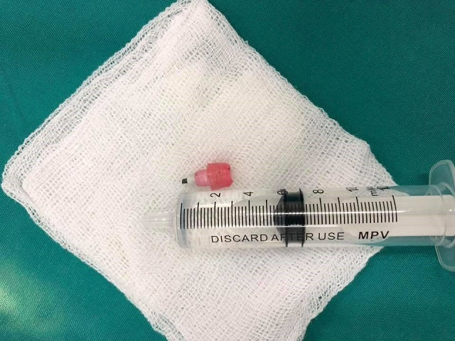 Cứu sống bé trai ngừng tim do nuốt đầu bút chì