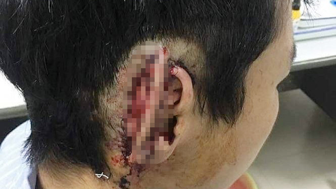 Các bác sỹ nối lại tai cho nam sinh bị bạn cắn đứt