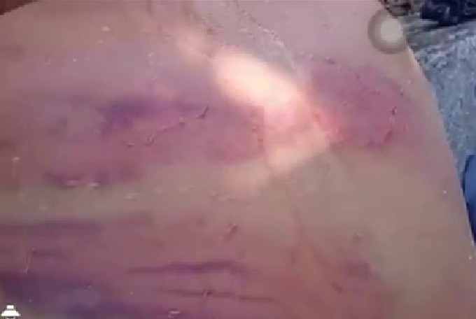 Dư luận bức xúc clip người đàn ông mù bị nhiều vết thương bầm tím 