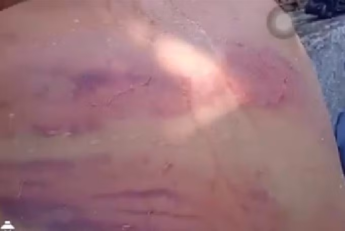 Dư luận bức xúc clip người đàn ông mù bị nhiều vết thương bầm tím 