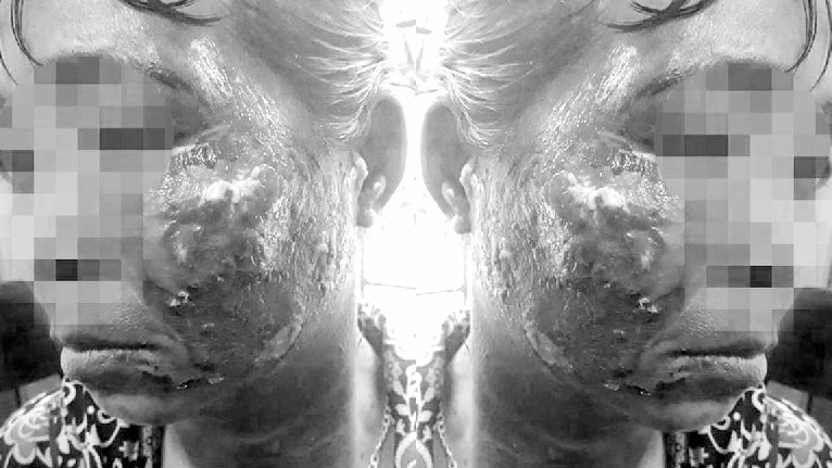 Chị H bị bỏng nặng ở vùng mặt và cổ. Ảnh: Báo Nghệ An