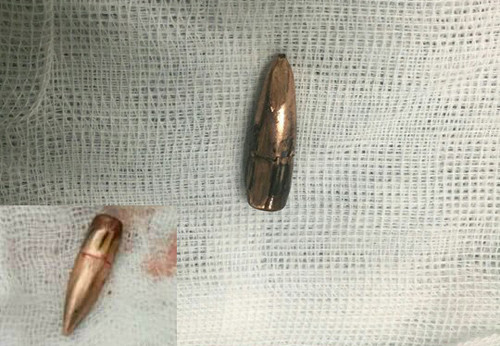 Đạn lạc găm vào người đàn ông giữa đồng ngô