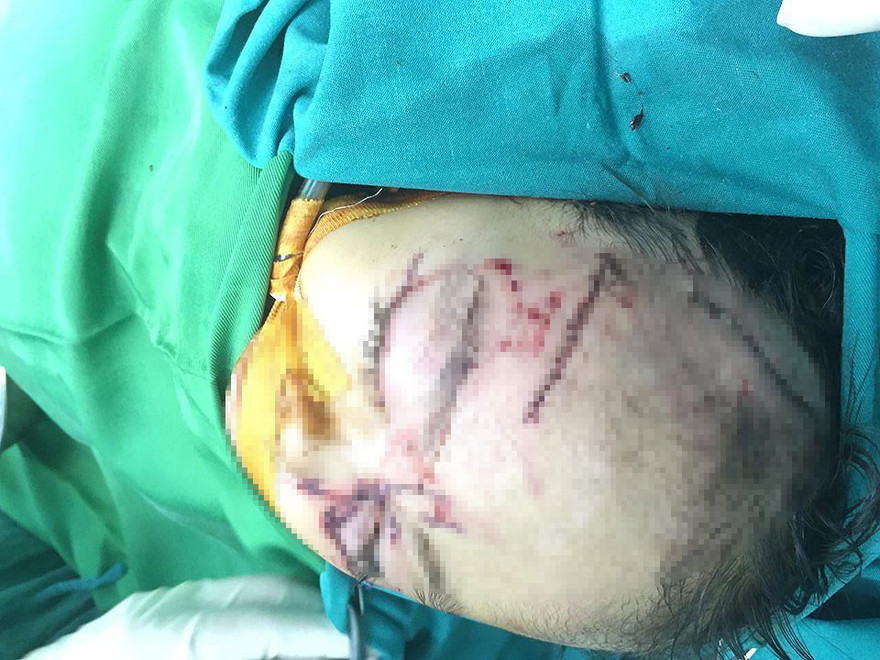 Bé Y. đang được điều trị tích cực tại bệnh viện. 