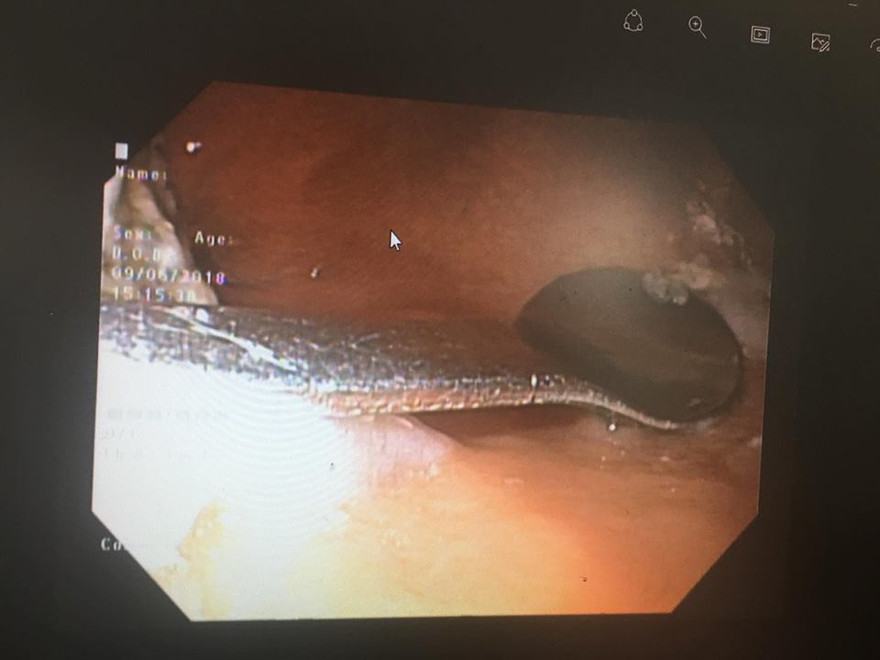 Hi hữu: Đi uống cà phê, cô gái 20 tuổi lỡ nuốt thìa sắt vào bụng