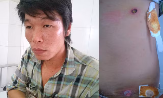 Anh Khảm trình bày sự việc và vết thương do công an thị trấn Đầm Dơi bắn. Ảnh: Dân Việt