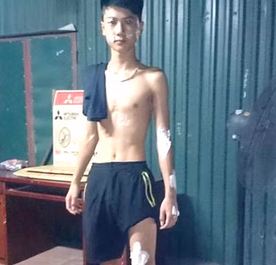 Một người đi đường bị bỏng do a xít trong xe tải bắn ra ngoài