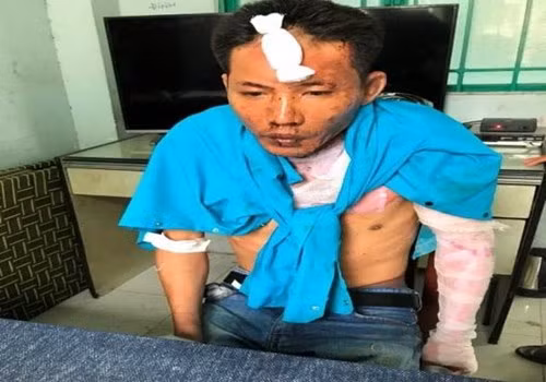 Nghi can Nguyễn Quang Dũng cũng bị bỏng nhẹ sau vụ việc