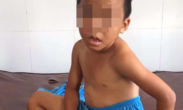 Vết thương trên người bé H.