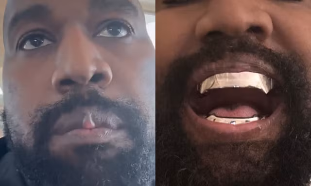 Gương mặt biến dạng của Kanye West sau khi nhổ hết răng