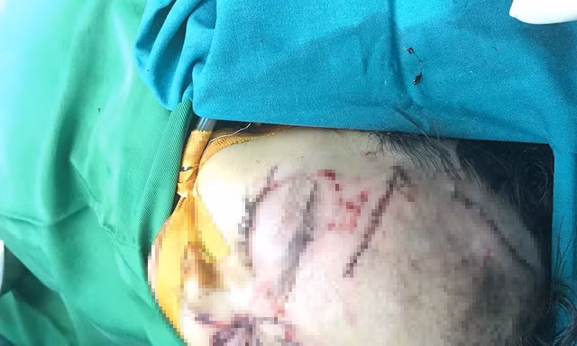 Bé Y. đang được điều trị tích cực tại bệnh viện. 