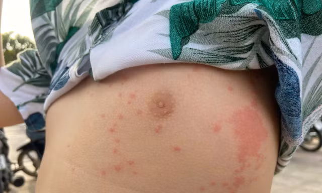 Nhiều người bị sứa lửa 'tấn công' khi tắm biển Nha Trang
