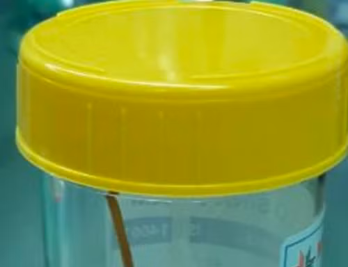 Tăm xỉa răng dài 6cm đâm thủng ruột bé trai 14 tuổi
