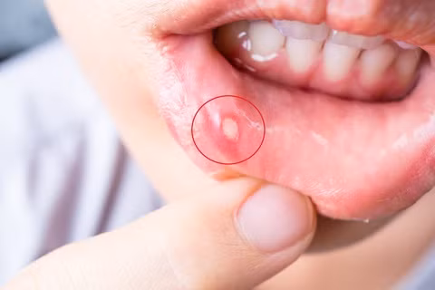 Thủ phạm gây nhiệt miệng