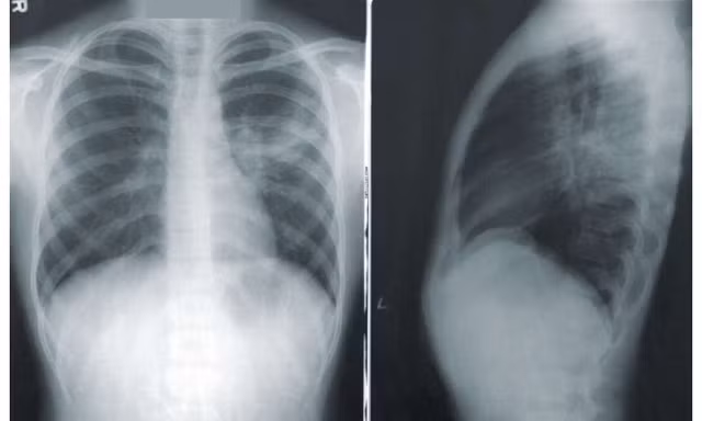Tìm ra nguyên nhân vì sao nhiều người không bao giờ hút thuốc lá lại bị ung thư phổi
