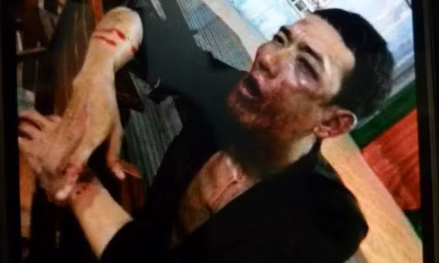 8X tố bị cán bộ khu phố đánh hội đồng gãy hết xương hàm