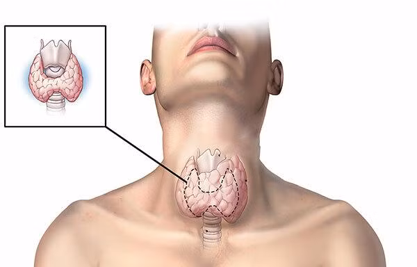Dấu hiệu bất thường cảnh báo nguy cơ bị ung thư tuyến giáp, tuyệt đối không được bỏ qua