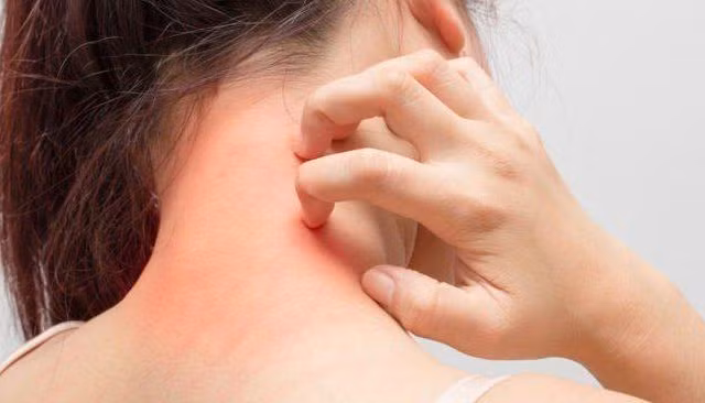 Ngứa da điên cuồng, có thể bạn đã mắc phải một trong các 'bệnh trọng' sau