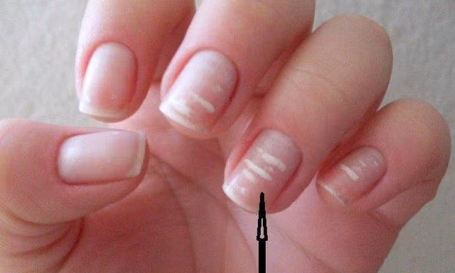 Dấu hiệu từ móng tay cảnh báo bệnh về gan, khớp, thậm chí ung thư