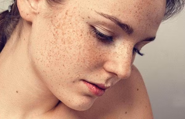 Những bộ phận trên cơ thể rất dễ bị ung thư da nhưng ít ai để ý