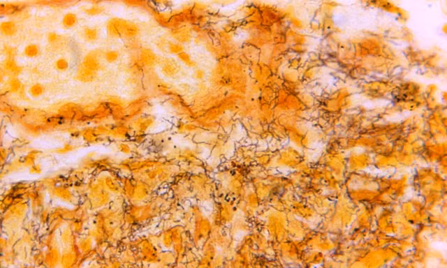 Các chuyên gia cảnh báo dịch bệnh lây nhiễm qua đường tình dục ở Mỹ đang ngoài tầm kiểm soát 