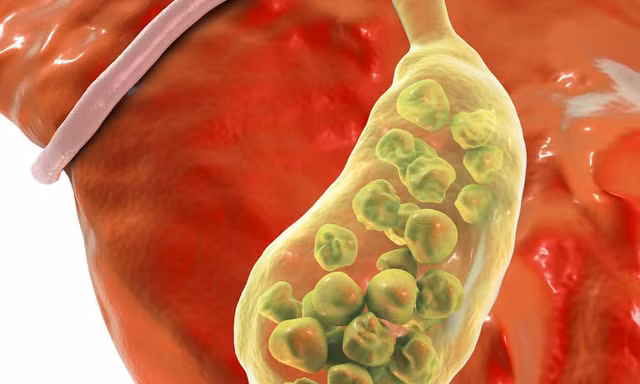 Chỉ đau lưng, người phụ nữ bất ngờ khi đi khám bác sĩ gắp ra 382 viên sỏi