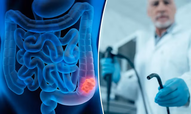 Nghiên cứu mới: Nội soi đại tràng có thể không hiệu quả như mong muốn 