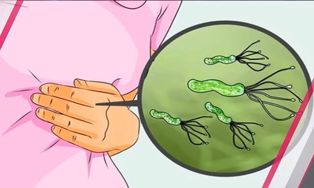 80% dân số Việt Nam nhiễm vi khuẩn HP trong đường tiêu hóa