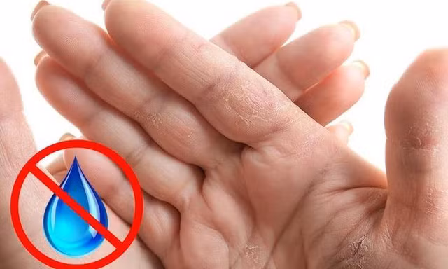 Bất thường ở bàn tay tiết lộ gì về sức khỏe?