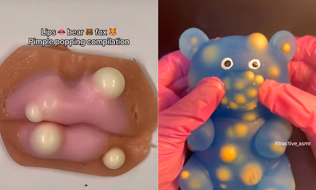 Thỏa mãn cơn ghiền với món đồ chơi lấy nhân mụn đang gây sốt mạng xã hội