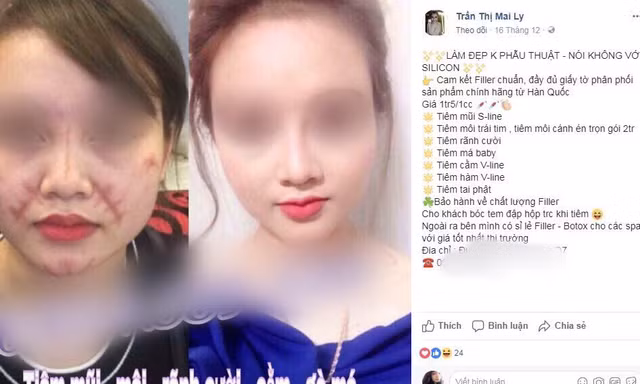 Tiêm filler: Sau công dụng 'thần tiên', làm nhanh giá rẻ là ẩn họa khôn lường!