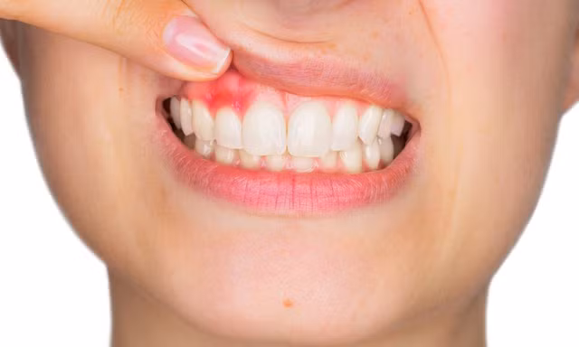 Những cách đơn giản mà hiệu quả khắc phục đau răng sau Tết 