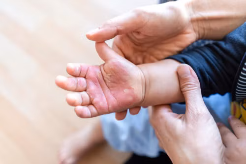Bác sĩ cảnh báo: Gia tăng trẻ bị tai nạn thời điểm cận Tết 